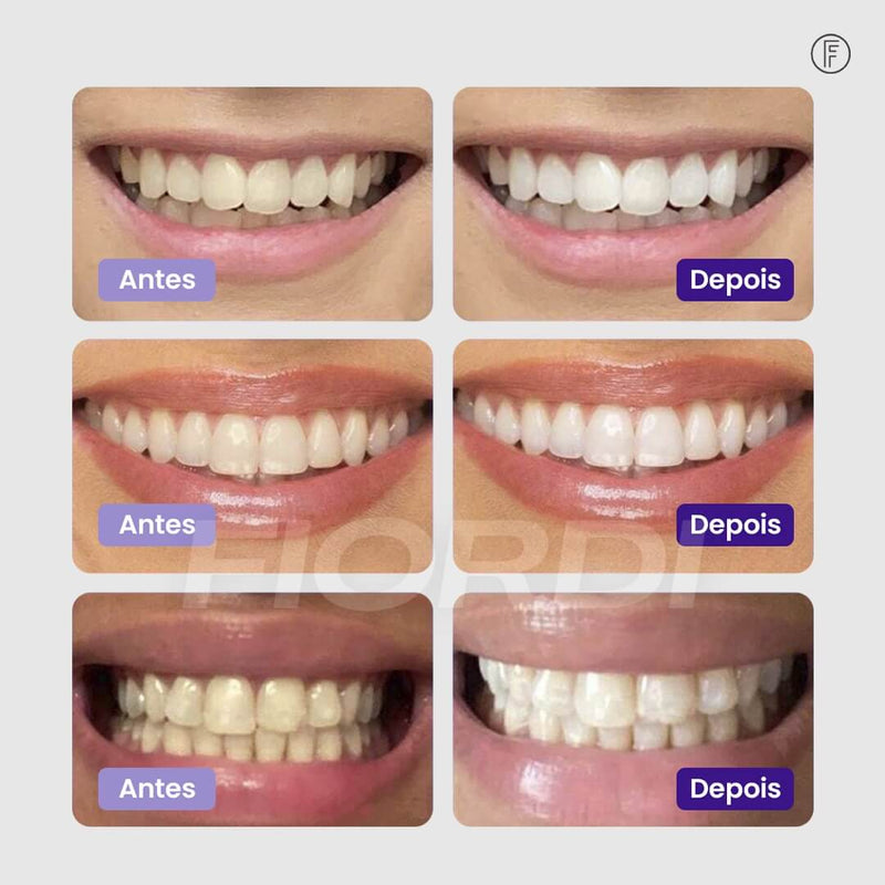 Clareador Dentário - Sérum V34™ + Brinde